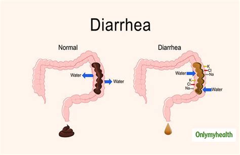 Rarely, it can cause serious medical complications. . Is paradoxical diarrhea dangerous